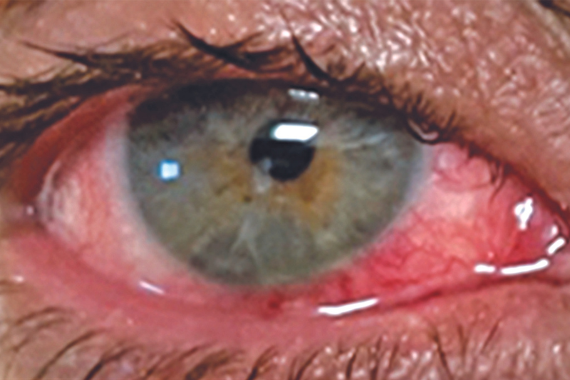 A Varíola do Macaco pode afetar os olhos