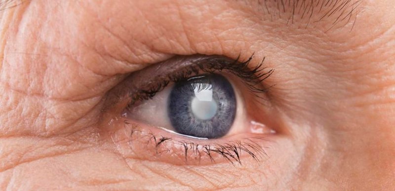 Número de cirurgias de catarata realizadas pelo SUS dobra desde 2009 e oftalmologistas alertam sobre importância da prevenção