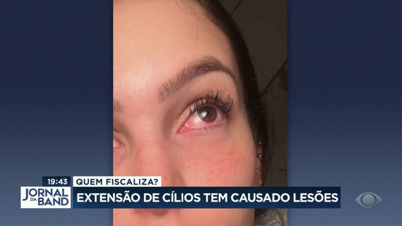 Extensão de cílios tem causado lesões